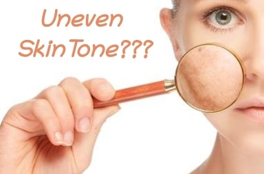 5 Secret Solutions to Manage Uneven Skin Tone